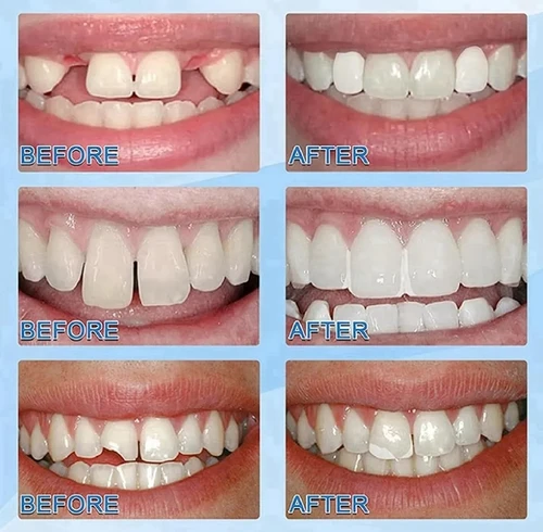 ایمپلنت فوری دندان ( نقد و اقساط ) جای خالی دندانت را خودت پر کن پروتز جادویی TEMPORARY TEETH اصل