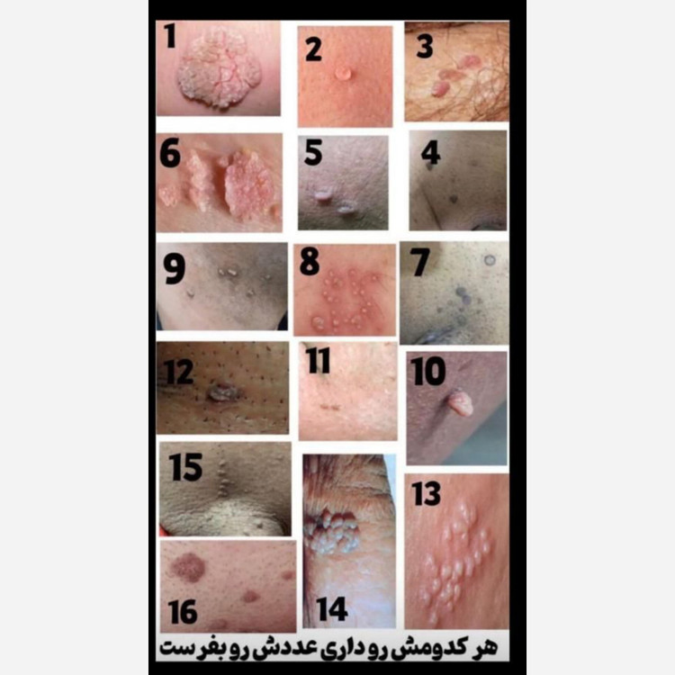 محلول زگیل تناسلی در یک جلسه