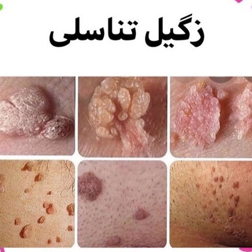 محلول زگیل تناسلی در یک جلسه