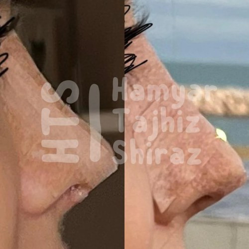 چسب بینی 3m اصل با نشان CE اروپا،ضد حساسیت و رنگ پوست